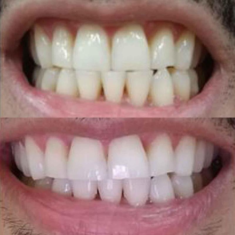 Nano-Hydroxyapatite Whitening Toothpaste test 1a