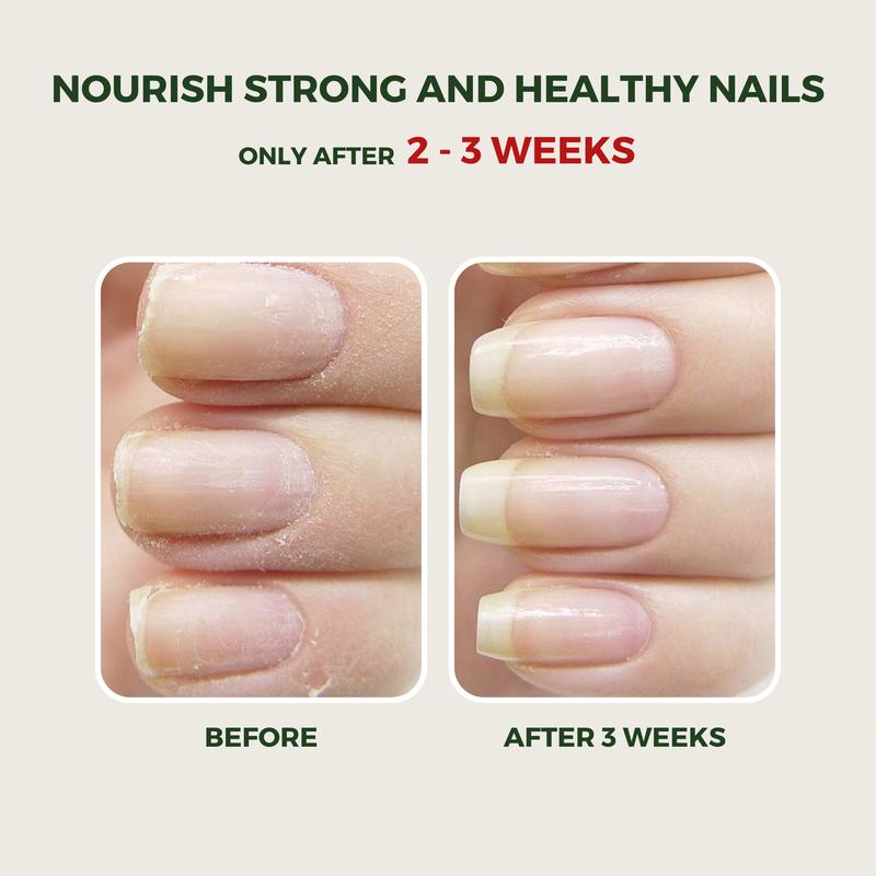 ABERA Nail Fungus Serum - For Strong Nails - 0.68 fl. Oz