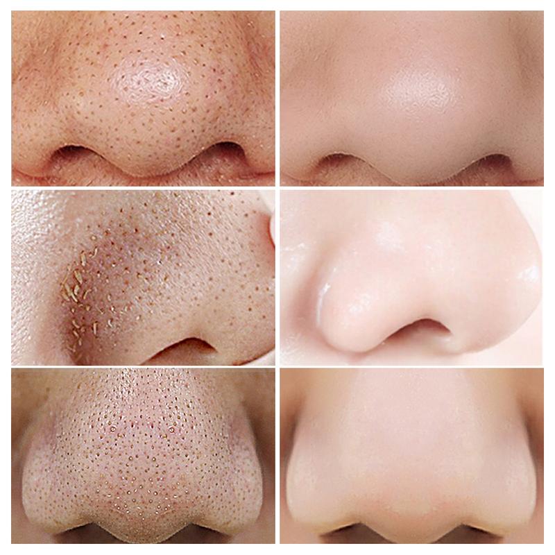 LANBENA Blackhead Remover Serum Shrink Pore Facial Serum Peeling Off Mask Skincare Acne Treatment Essence 17ml Comfort Skin Repair