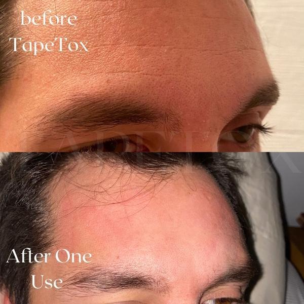 TapeTox Natural Wrinkle Smoothers - Skincare Facial Comfort