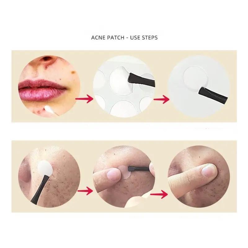 Round Acne Cover Sticker, Invisible Acne Cover Patches, Acne Spot Covering Sticker, Facial Skincare Tools for Daily Use