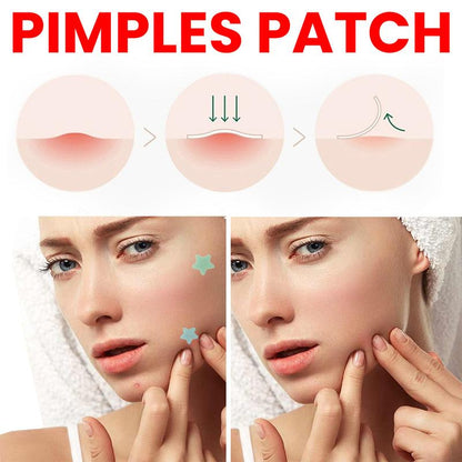 Pimple Patches for Face,star pimple patches, pimple patches stars  ,Colorful Spot Stickers with Tea Tree, Salicylic Acid & Cica Oil| 3 Sizes (10mm, 12mm & 14mm) |200 Count